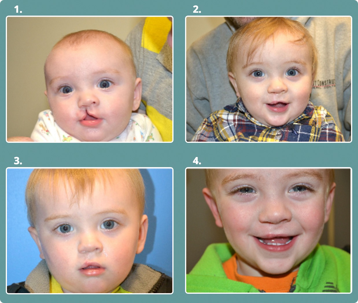 Albums 105+ Images cleft palate before and after surgery photos Stunning