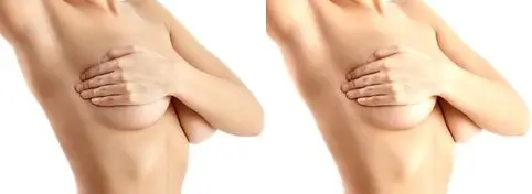 Breast